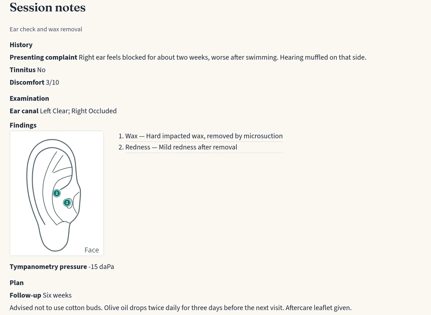 A finished session note written from the ear template: answers grouped under History, Examination and Plan, and an ear chart with two numbered pins, 1 for impacted wax and 2 for mild redness, each listed beside the chart.